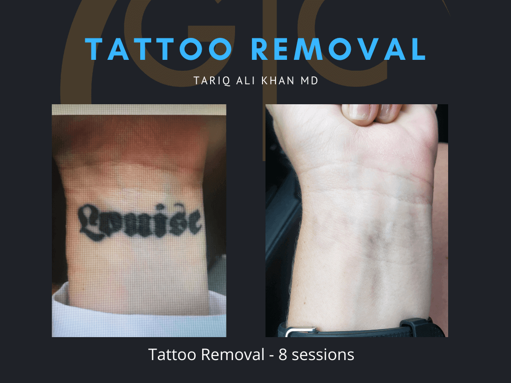 Gentle Care Laser Tustin & Long Beach CA Before and After picture - Tattoo Removal